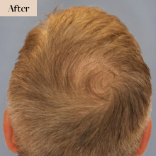 neograft hair transplant white plains after treatment image